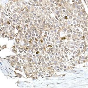 Immunohistochemistry analysis of paraffin-embedded human esophageal cancer using Anti-TPX2 Antibody (A307828) at a dilution of 1:100 (40x lens). Perform high pressure antigen retrieval with 10 mM citrate buffer pH 6.0 before commencing with IHC staining protocol.