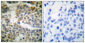 Immunohistochemical analysis of paraffin-embedded human breast cancer using Anti-Shc Antibody 1:100 (4°C overnight) The right hand panel represents a negative control, where the antibody was pre-incubated with the immunising peptide