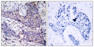 Immunohistochemical analysis of paraffin-embedded human breast carcinoma tissue using Anti-BAD Antibody. The right hand panel represents a negative control, where the Antibody was pre-incubated with the immunising peptide