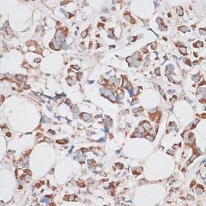 Immunohistochemistry analysis of paraffin-embedded human breast cancer tissue using Anti-KIF14 Antibody (A8568) at a dilution of 1:100 (40x lens) Perform microwave antigen retrieval with 10 mM PBS buffer pH 72 before commencing with IHC staining protocol