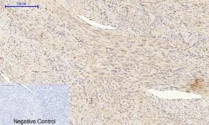 Immunohistochemical analysis of paraffin-embedded human uterus cancer tissue using Anti-BAD Antibody at 1:200 (4 °C overnight). Negative control was secondary antibody only