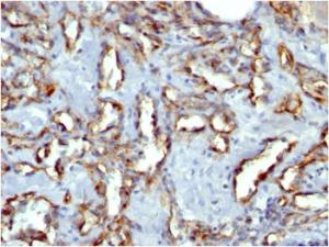 Immunohistochemical analysis of formalin-fixed, paraffin-embedded human angiosarcoma using Anti-CD31 Antibody [C31.7]