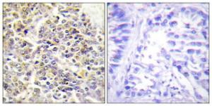 Immunohistochemical analysis of paraffin-embedded human lung carcinoma tissue using Anti-ASC Antibody. The right hand panel represents a negative control, where the antibody was pre-incubated with the immunising peptide