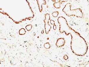 Immunohistochemical analysis of formalin-fixed, paraffin-embedded human breast carcinoma using Anti-Calponin 1 Antibody [CNN1/832 + CALP]