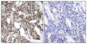 Immunohistochemical analysis of paraffin-embedded human breast carcinoma tissue using Anti-Akt Antibody The right hand panel represents a negative control, where the antibody was pre-incubated with the immunising peptide