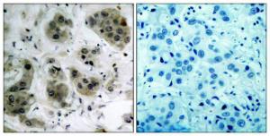 Immunohistochemical analysis of paraffin-embedded human breast carcinoma tissue using Anti-Akt Antibody The right hand panel represents a negative control, where the antibody was pre-incubated with the immunising peptide