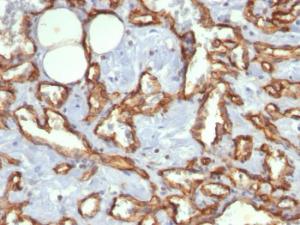 Immunohistochemical analysis of formalin-fixed, paraffin-embedded human angiosarcoma using Anti-CD31 Antibody [C31.3]