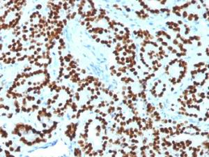 Immunohistochemical analysis of formalin-fixed, paraffin-embedded human prostate carcinoma using Anti-FOXA1 Antibody [FOXA1/1518]