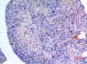 Immunohistochemical analysis of paraffin-embedded human liver cancer using Anti-BMP3 Antibody