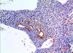 Immunohistochemical analysis of paraffin-embedded human liver cancer using Anti-BMP3 Antibody