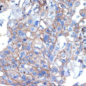 Immunohistochemistry analysis of paraffin-embedded human lung cancer using Anti-Talin 2 Antibody [ARC2335] (A309077) at a dilution of 1:100 (40X lens). Perform microwave antigen retrieval with 10 mM Tris/EDTA buffer pH 9.0 before commencing with IHC staining protocol