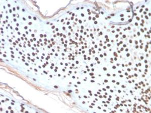 Immunohistochemical analysis of formalin-fixed, paraffin-embedded human skin basal cell carcinoma using Anti-Histone H1 Antibody [AE-4]