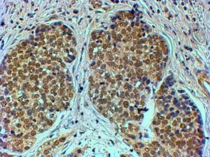 Anti-TRIM24 Antibody (A83286) (4 µg/ml) staining of paraffin embedded Human Breast cancer. Steamed antigen retrieval with citrate buffer pH 6, HRP-staining