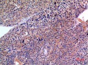 Immunohistochemical analysis of paraffin-embedded human liver cancer using Anti-SERPINB3 + SERPINB4 Antibody