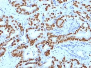 Immunohistochemical analysis of formalin-fixed, paraffin-embedded human prostate carcinoma using Anti-FOXA1 Antibody [FOXA1/1519]