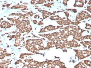 Immunohistochemical analysis of formalin-fixed, paraffin-embedded human breast carcinoma using Anti-Histone H1 Antibody [AE-4]