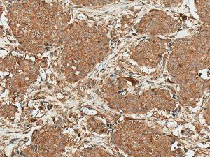 Immunohistochemistry analysis of human breast cancer, fixed in formalin and paraffin-embedded. The Primary Antibody used was Anti-ROR1 Antibody (A305046) at 1:50 for 30 minutes at room temperature. Counterstain: Hematoxylin. Magnification: 20X. HRP-DAB Detection.