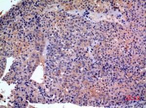 Immunohistochemical analysis of paraffin-embedded human liver cancer using Anti-SERPINB3 + SERPINB4 Antibody