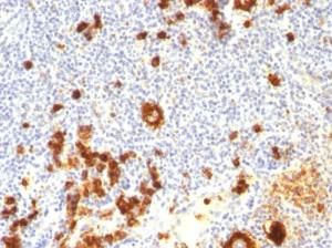 Immunohistochemical analysis of formalin-fixed, paraffin-embedded human Hodgkin's lymphoma using Anti-CD15 Antibody [FUT4/815 + BRA-4F1]