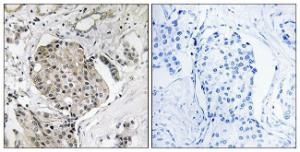 Immunohistochemical analysis of paraffin-embedded human breast carcinoma using Anti-USP40 Antibody The right hand panel represents a negative control, where the antibody was pre-incubated with the immunising peptide