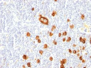 Immunohistochemical analysis of formalin-fixed, paraffin-embedded human Hodgkin's lymphoma using Anti-CD15 Antibody [FUT4/815]