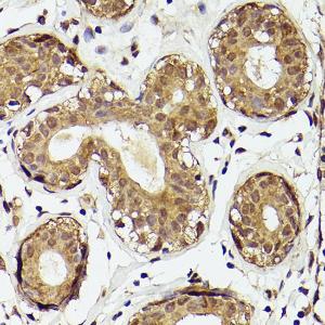 Immunohistochemistry analysis of paraffin-embedded human breast cancer tissue using Anti-PTEN Antibody (A93003) at a dilution of 1:50 (40x lens). Perform high pressure antigen retrieval with 10 mM citrate buffer pH 6.0 before commencing with IHC staining protocol.