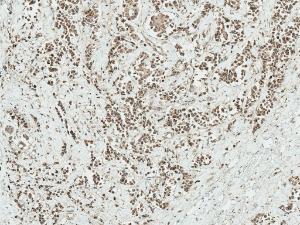 Immunohistochemistry analysis of human breast cancer, fixed in formalin and paraffin-embedded. The Primary Antibody used was Anti-AKT1 Antibody (A305050) at 1:50 for 30  minutes at room temperature. Counterstain: Hematoxylin. Magnification: 10X. HRP-DAB Detection