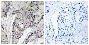 Immunohistochemical analysis of paraffin-embedded human breast carcinoma using Anti-THBS4 Antibody. The right hand panel represents a negative control, where the antibody was pre-incubated with the immunising peptide