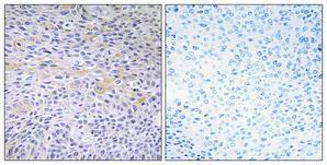 Immunohistochemical analysis of paraffin-embedded human cervix cancer using Anti-FAK Antibody 1:100 (4°C overnight). The right hand panel represents a negative control, where the antibody was pre-incubated with the immunising peptide