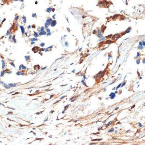 Immunohistochemistry analysis of paraffin-embedded human lung cancer using Anti-JNK1 + JNK2 + JNK3 Antibody (A307842) at a dilution of 1:100 (40X lens). Perform microwave antigen retrieval with 10 mM Tris/EDTA buffer pH 9.0 before commencing with IHC staining protocol