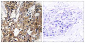 Immunohistochemical analysis of paraffin-embedded human breast carcinoma tissue using Anti-CD9 Antibody. The right hand panel represents a negative control, where the antibody was pre-incubated with the immunising peptide