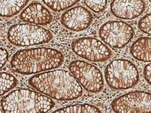 Immunohistochemistry analysis of human colon cancer, fixed in formalin and paraffin-embedded. The Primary Antibody used was Anti-HSP70 (Acetyl Lys77) Antibody (A305054) at 1:50 for 30 minutes at room temperature. Counterstain: Hematoxylin. Magnification: 20X. HRP-DAB Detection