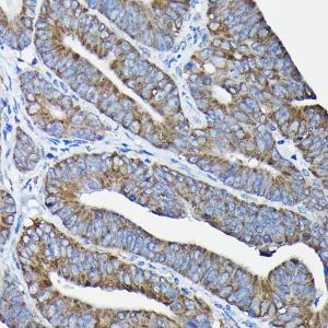 Immunohistochemistry analysis of paraffin-embedded human colon carcinoma tissue using Anti-Nesprin1/Syne-1 Antibody (A306171) at a dilution of 1:100 (40X lens). Perform high pressure antigen retrieval with 10 mM citrate buffer pH 6.0 before commencing with IHC staining protocol