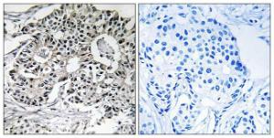 Immunohistochemical analysis of paraffin-embedded human breast carcinoma using Anti-PXMP2 Antibody. The right hand panel represents a negative control, where the antibody was pre-incubated with the immunising peptide