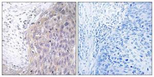 Immunohistochemical analysis of paraffin-embedded human cervix carcinoma tissue using Anti-POLG2 Antibody. The right hand panel represents a negative control, where the antibody was pre-incubated with the immunising peptide