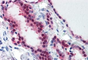 Anti-TIA1 Antibody (A83311) (375 µg/ml) staining of paraffin embedded Human Thyroid Steamed antigen retrieval with citrate buffer pH 6, AP-staining