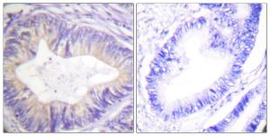 Immunohistochemical analysis of paraffin-embedded human colon carcinoma tissue using Anti-CBL Antibody. The right hand panel represents a negative control, where the antibody was pre-incubated with the immunising peptide.