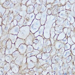 Immunohistochemistry analysis of paraffin-embedded human esophageal cancer using Anti-CD44 Antibody (A93018) at a dilution of 1:200 (40x lens) Perform high pressure antigen retrieval with 10 mM citrate buffer pH 60 before commencing with IHC staining protocol