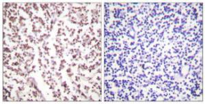 Immunohistochemical analysis of paraffin-embedded human lymph node tissue using Anti-Bloom Syndrome Antibody. The right hand panel represents a negative control, where the antibody was pre-incubated with the immunising peptide