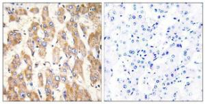 Immunohistochemical analysis of paraffin-embedded human liver carcinoma using Anti-BAX Antibody. The right hand panel represents a negative control, where the Antibody was pre-incubated with the immunising peptide