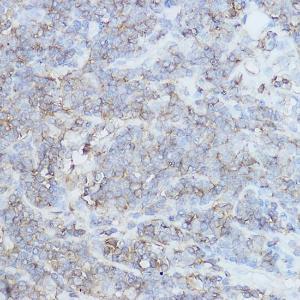 Immunohistochemistry analysis of paraffin-embedded human lung cancer using Anti-CD44 Antibody (A93018) at a dilution of 1:200 (40x lens) Perform high pressure antigen retrieval with 10 mM citrate buffer pH 60 before commencing with IHC staining protocol