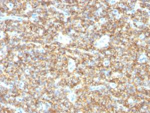 Immunohistochemical analysis of formalin-fixed, paraffin-embedded human Ewing's sarcoma using Anti-CD99 Antibody [HO36-1.1]