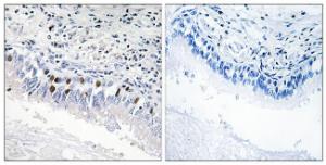 Immunohistochemical analysis of paraffin-embedded human lung carcinoma using Anti-MED12 Antibody. The right hand panel represents a negative control, where the antibody was pre-incubated with the immunising peptide.