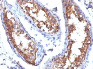 Immunohistochemical analysis of formalin-fixed, paraffin-embedded human testicular carcinoma using Anti-CD99 Antibody [HO36-1.1]