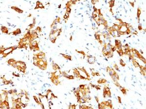 Immunohistochemical analysis of formalin-fixed, paraffin-embedded human breast carcinoma using Anti-HSP27 Antibody [SPM252]