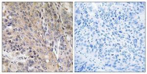 Immunohistochemical analysis of paraffin-embedded human lung carcinoma using Anti-LAMP3 Antibody. The right hand panel represents a negative control, where the antibody was pre-incubated with the immunising peptide.