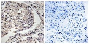 Immunohistochemical analysis of paraffin-embedded human breast carcinoma tissue using Anti-MLK1 + MLK2 Antibody. The right hand panel represents a negative control, where the antibody was pre-incubated with the immunising peptide