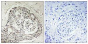 Immunohistochemical analysis of paraffin-embedded human breast carcinoma using Anti-K0100 Antibody. The right hand panel represents a negative control, where the Antibody was pre-incubated with the immunising peptide