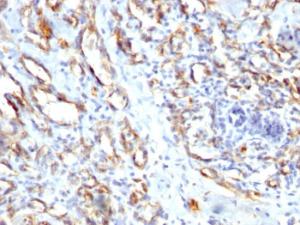 Immunohistochemical analysis of formalin-fixed, paraffin-embedded human angiosarcoma using Anti-CD31 Antibody