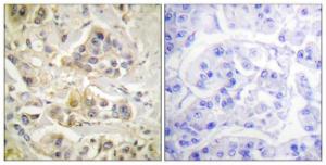 Immunohistochemical analysis of paraffin-embedded human breast carcinoma tissue using Anti-AhR Antibody. The right hand panel represents a negative control, where the antibody was pre-incubated with the immunising peptide.